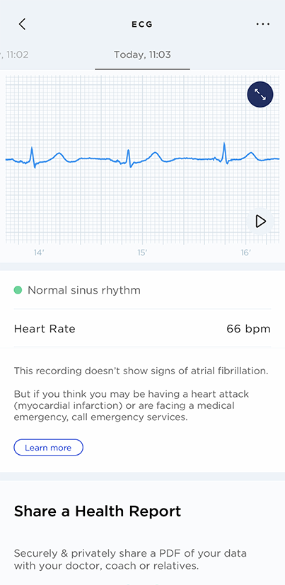 scanwatch-ecg-recording.png