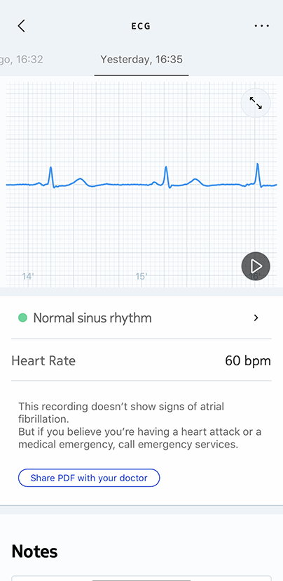 Repeated inconclusive ecg discount on apple watch